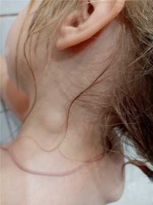 лимфоузел увеличен у ребенка фото