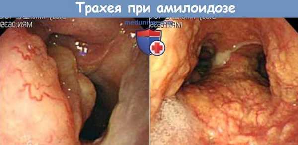Трахея при амилоидозе