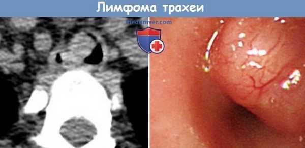 Лимфома трахеи