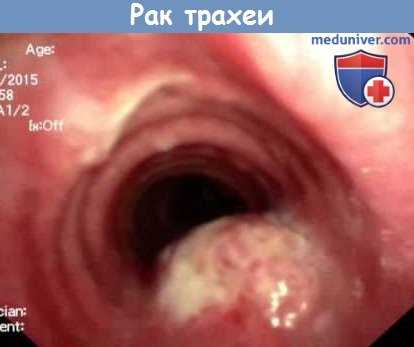 Рак трахеи