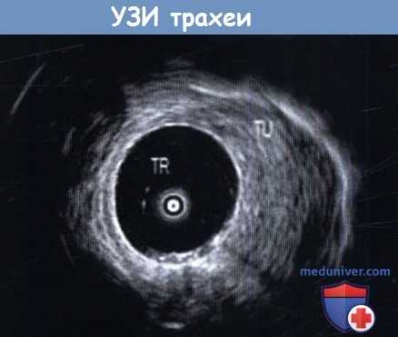 УЗИ трахеи