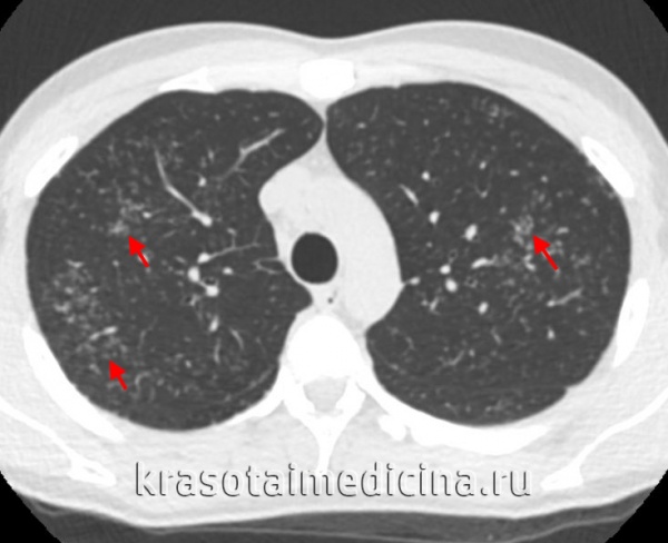 Саркоидоз легких