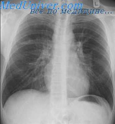 комплемент при саркоидозе