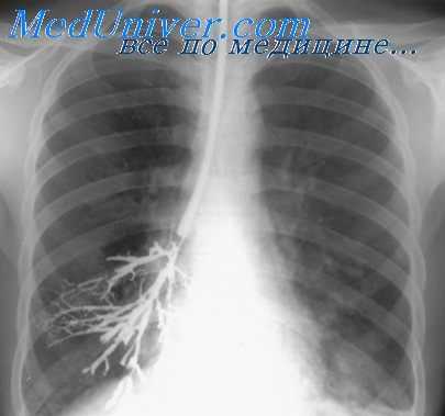 бронхография