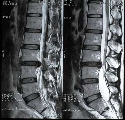 подготовка к МРТ позвоночника с миелографией