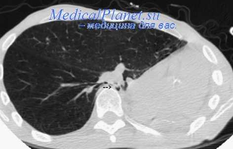Пневмонэктомия с торакопластикой