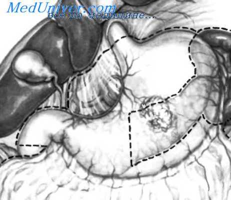 этапы тотальной гастрэктомии