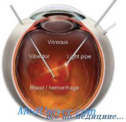 витрэктомия