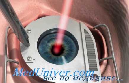 обеспечение визуализации при витрэктомии