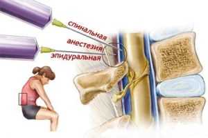 анестезия при родах
