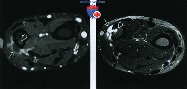 Рентгенограмма, КТ, МРТ при периостальной остеосаркоме