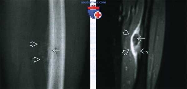 Рентгенограмма, КТ, МРТ при периостальной остеосаркоме