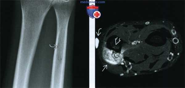 Рентгенограмма, КТ, МРТ при периостальной остеосаркоме