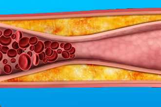 Атеросклероз сосудов головного мозга