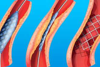 Атеросклероз сосудов головного мозга