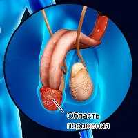 Нефротический синдром