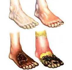 Облитерирующий эндартериит