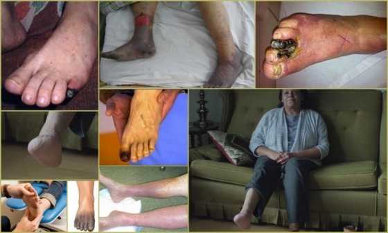 Облитерирующий тромбангиит - внешние проявления патологии