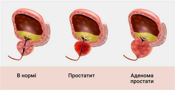 Излечима ли аденома простаты