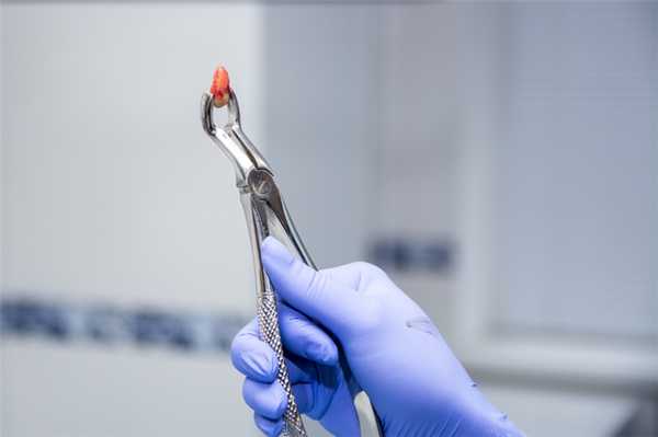 врач держит пинцетом удаленный зуб