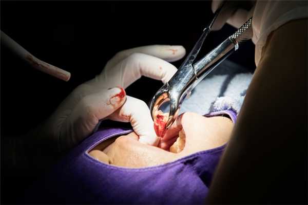 стоматолог удалил зуб