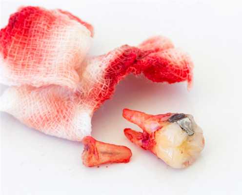 вырванный зуб