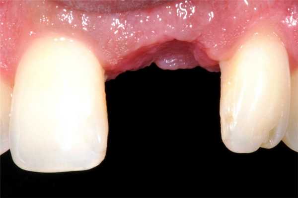 заросшая лунка удаленного зуба