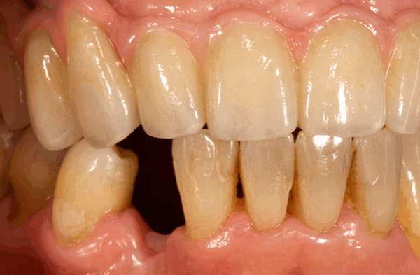 удалён нижний зуб