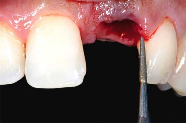 лунка от удалённого зуба