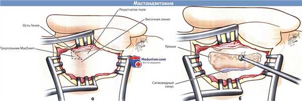 Мастоидэктомия