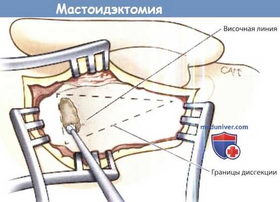 Мастоидэктомия