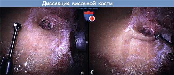 Диссекция височной кости в виде мастоидэктомии с сохранением стенки слухового прохода