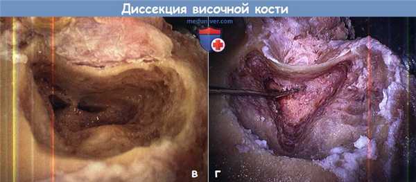 Диссекция височной кости в виде мастоидэктомии с сохранением стенки слухового прохода