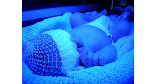 Лампы фототерапии