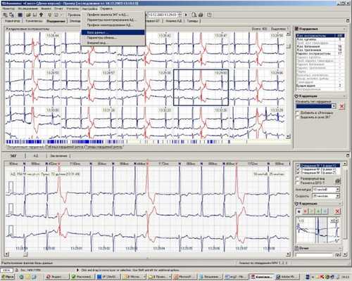 Расшифровка Холтер-ЭКГ на компьютере