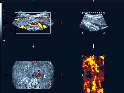 Плацента - режим энергетического допплера