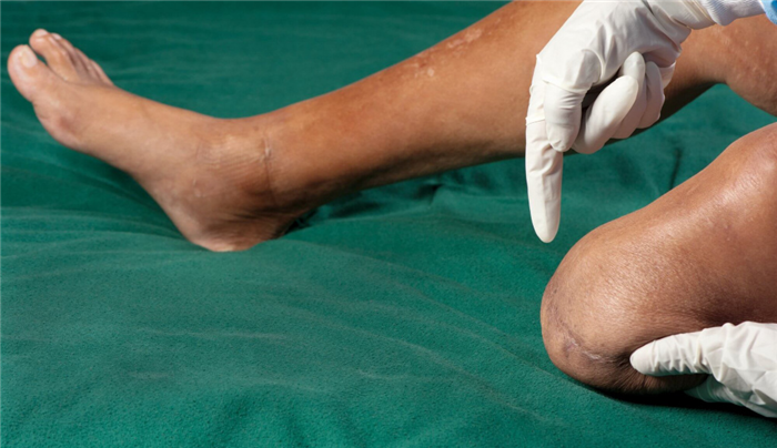 Ампутация нижних конечностей