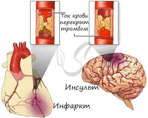Инфаркт и инсульт