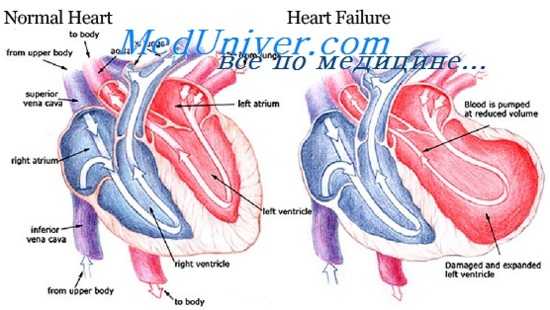 сердечная недостаточность