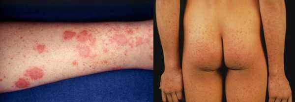Уртикарные высыпания в преджелтушном периоде заболевания