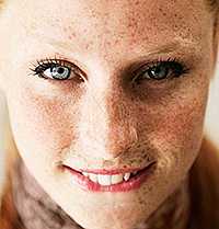 Гиперпигментация