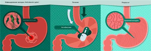 Болезни желудка.jpg