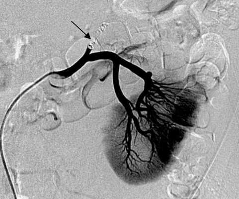 Эмболизация почки
