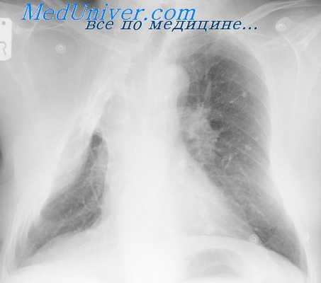 торакопластика