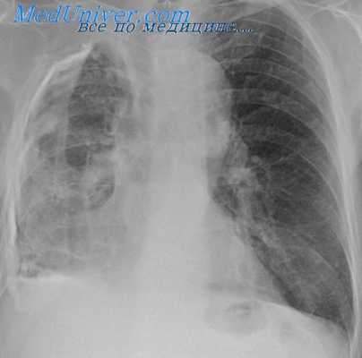 торакопластика