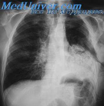 торакопластика