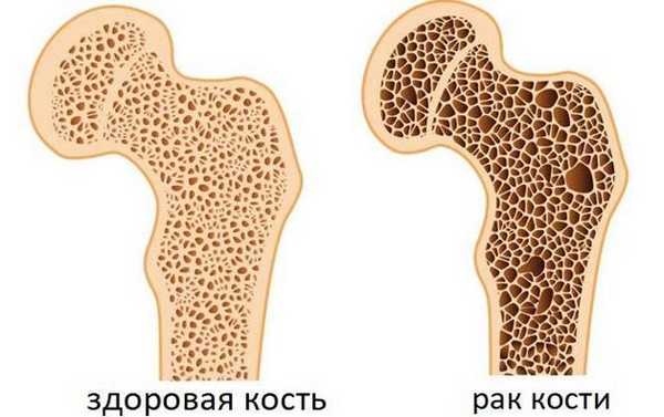 Рак костей