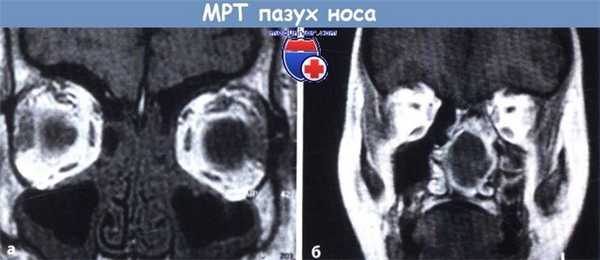 МРТ пазух носа