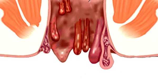 Анальная бахромка