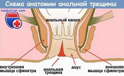 Анальная трещина - схема